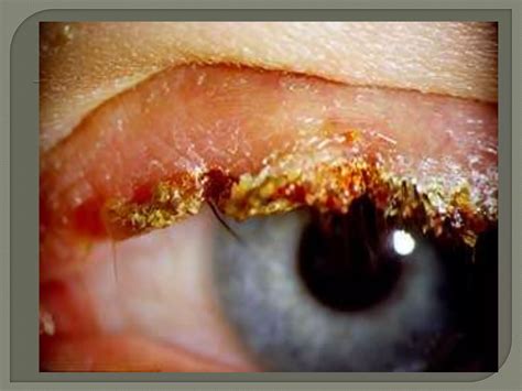 Eyelid Disorders.pptx