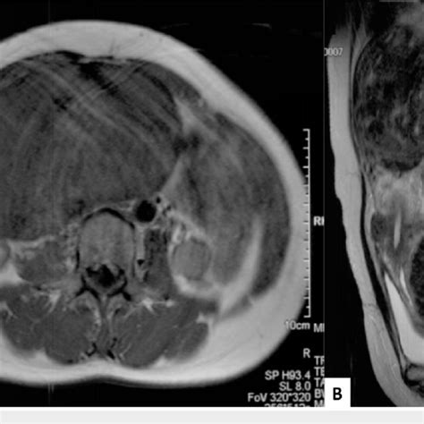 Mri Before Uterine Artery Embolization A Axial Image Shows Massive