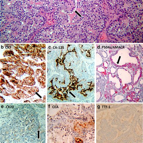 Lung Adenocarcinoma With Clear Cell Features A Hematoxylin And Eosin