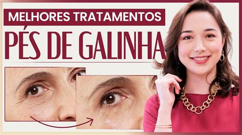 Rugas P De Galinha Como Amenizar Essas Linhas Na Rea Dos Olhos