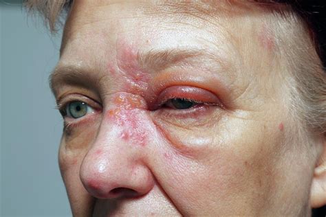 Shingles Rash Photograph By Victor De Schwanbergscience Photo Library