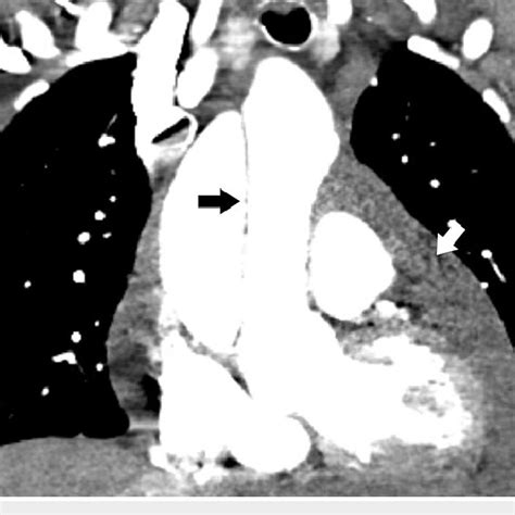 Chest radiograph showing a prominent and calcified aortic knob (white ...