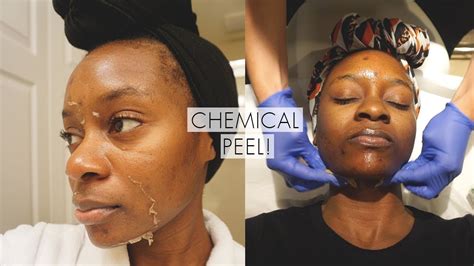 Before and After Chemical Peel Black Skin: See the WOW Results!