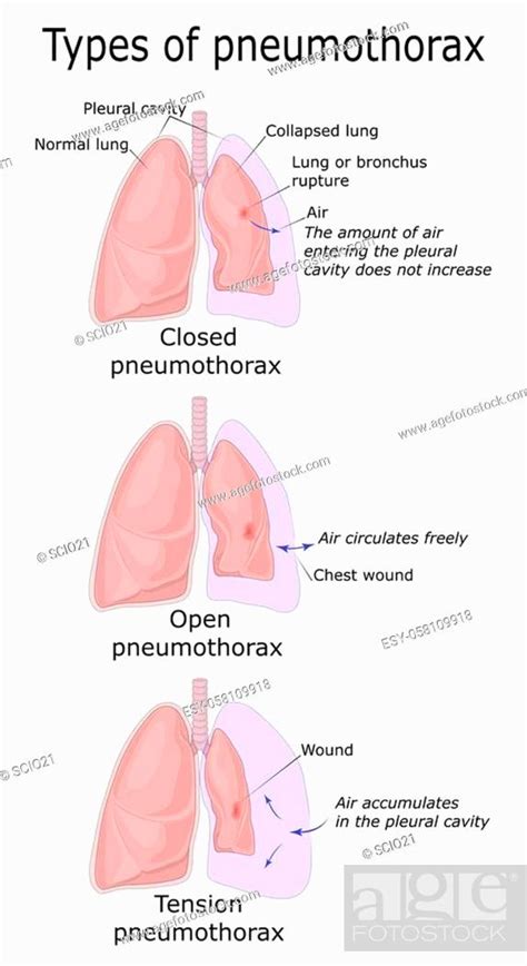 Open Pneumothorax Vs Tension Pneumothorax