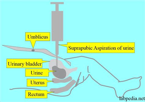 Urine Samples Type And Composition Labpedia Net