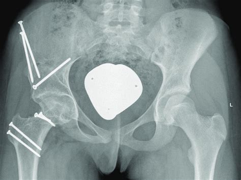 Case Two Anteroposterior Pelvic Radiograph Control Months After