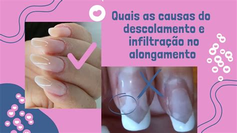 Quais As Causas Do Descolamento E Infiltra O Do Alongamento De Unhas