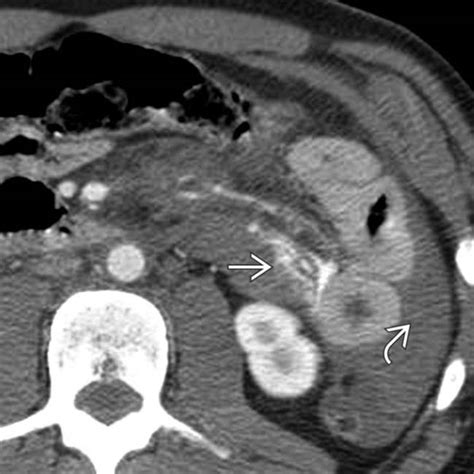 Mesenteric And Small Bowel Trauma Clinical Gate