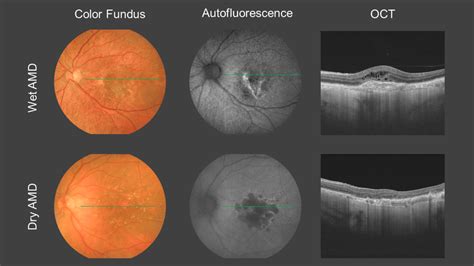 Representative Retinographies And Optical Coherence Tomography Oct Of