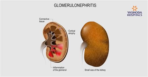 Glomerulonephritis Signs And Symptoms