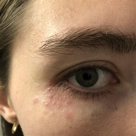 Small Red Bumps Under Eye 3 Weeks R Dermatologyquestions