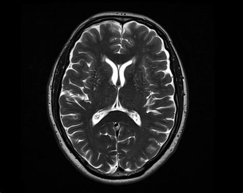 T2 Mri T2 Weighted Mri Sequence Physics And Image Appearance