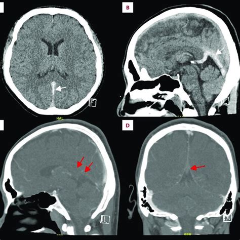 Axial A And Sagittal B Planes Of The Non Contrast Enhanced Computed