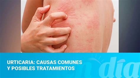 Urticaria Causas Comunes Y Posibles Tratamientos YouTube