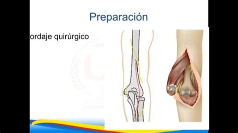 Osteosíntesis de fractura de humero distal pptx