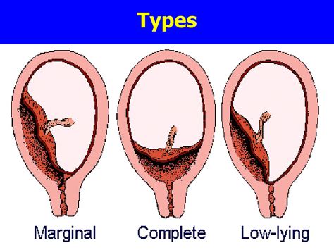 Ppt Antepartum Haemorrhage Aph Powerpoint Presentation Free Download Id4302347