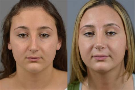 Nose Surgery Before After Long Island Dr Marotta