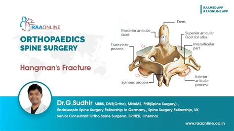 Hangman S Fracture Youtube