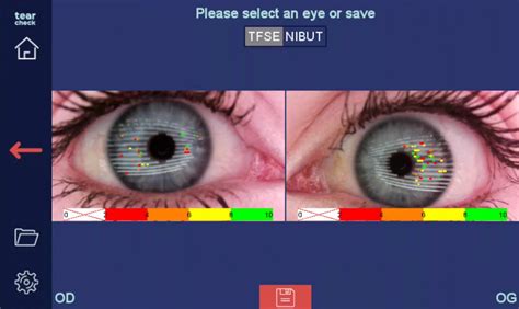 Tearcheck Diagnose Trockenes Auge Afidera