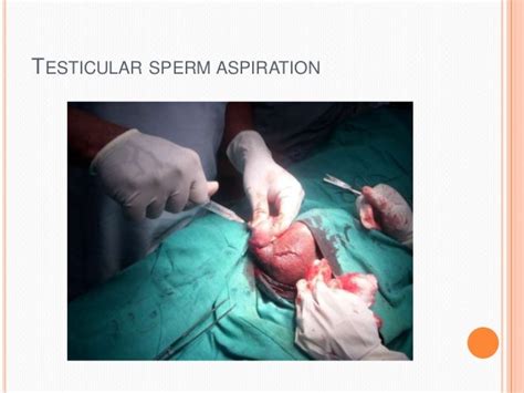 Semen Analysis In Fertility Management