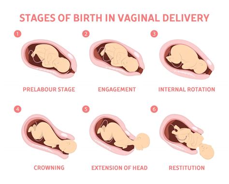 Etapas Del Parto En El Parto Vaginal Vector Premium