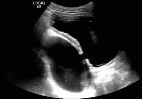 Bladder Diverticulum Ultrasound