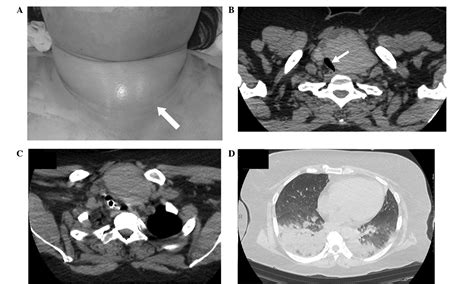 Multinodular Goiter Icd 10 Asking List