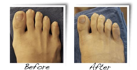 Hammer Toe Before And After