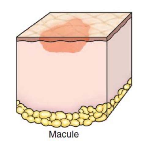 Dermatology Lesions Flashcards Quizlet