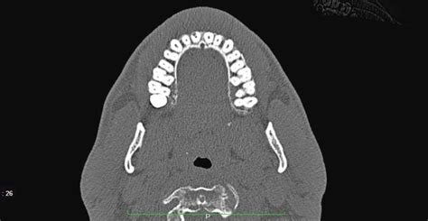 Indicazioni Allutilizzo Della Cbct In Parodontologia