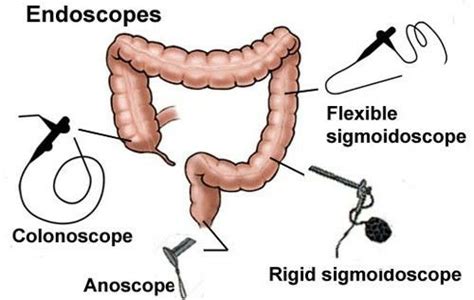 Sigmoidoscopy