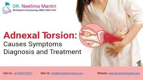 PPT - Adnexal Torsion: Causes, Symptoms, Diagnosis and Treatment | Dr ...