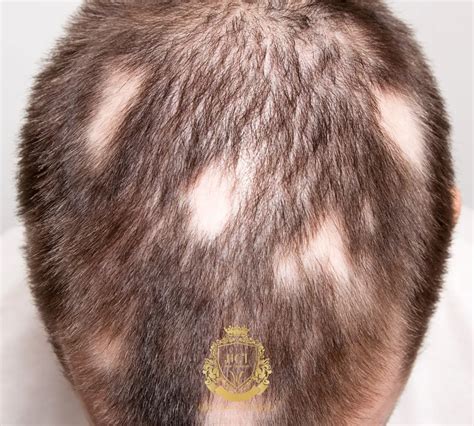 O Que Alopecia Areata