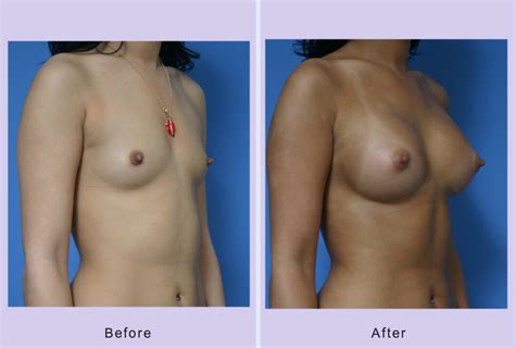 Breast Augmentation Case 22 Anthony Youn MD FACS