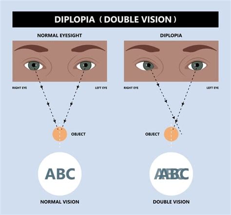 La Diplopía ¿cómo Afecta La Visión