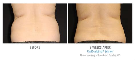 Your Guide To Coolsculpting® And Treatment Areas Freeze The Fat