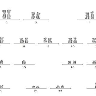 Karyotype showing 45,XY with trp(1)(q21q32) and del(5)(q22q35 ...