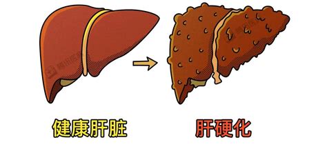 为什么有些人的肝，变得像石头一样硬 桂林生活网新闻中心