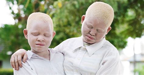 Albino Children Being Hunted Tanzania Photo Series