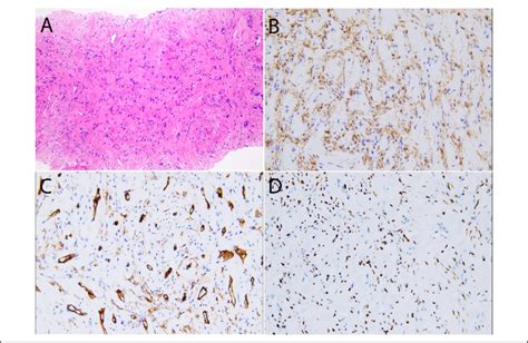 Morphological Features Of The Tumor On Liver Biopsy A Hande 100× Download Scientific Diagram