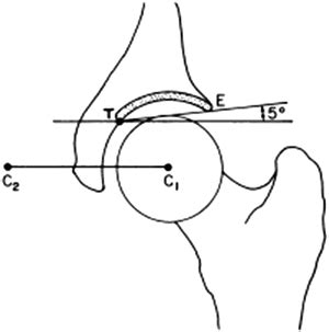 Skeletally Mature Acetabular Dysplasia: Epidemiology, Natural History ...