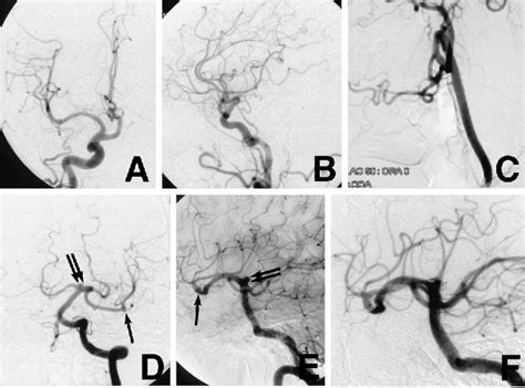 Figure 1 From Infraoptic Course Of The Anterior Cerebral Artery