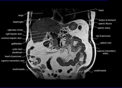 Anatomy Human Abdomen Mri Abdomen Coronal Anatomy Free Cross