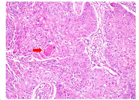 The figure shows the pathology after bronchoscopic biopsy ...