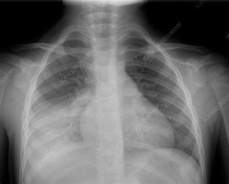 Left Lobar Pneumonia X Ray