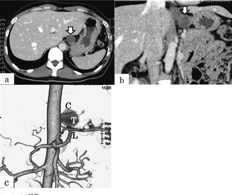 Figure 2 From A Case Of Gastric Bronchogenic Cyst Resected By