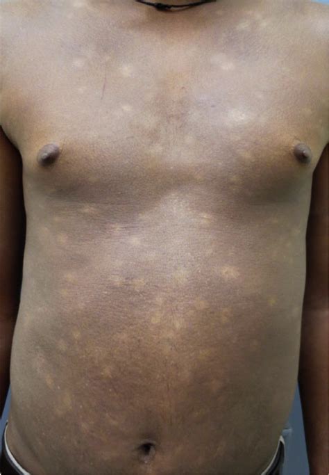 Acquired Disorders With Hypopigmentation A Clinical Approach To