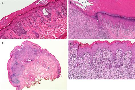 Acral And Vulvar Nevi Versus Acral Lentiginous Melanoma And Vulvar