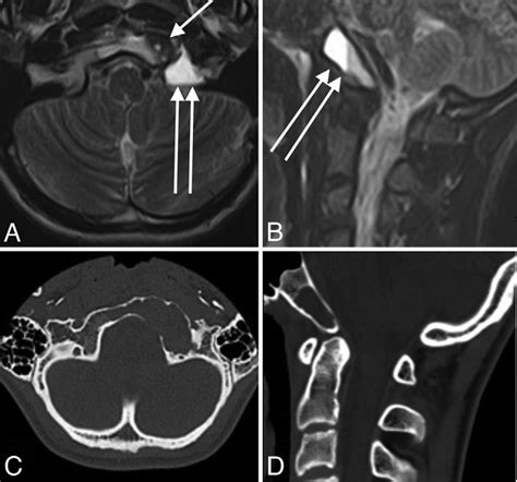 Pretreatment Skull Base MR And CT Images A Axial T2 Weighted MR Image