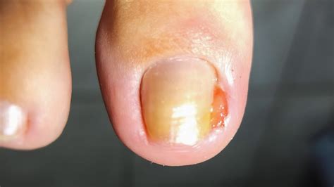 ENFERMEIRA A UNHA INFLAMADA E GRANULOMA Nail Podologomaurelio